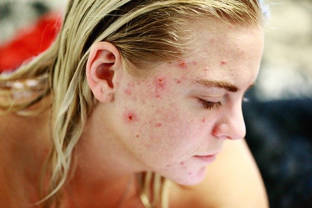 bad acne